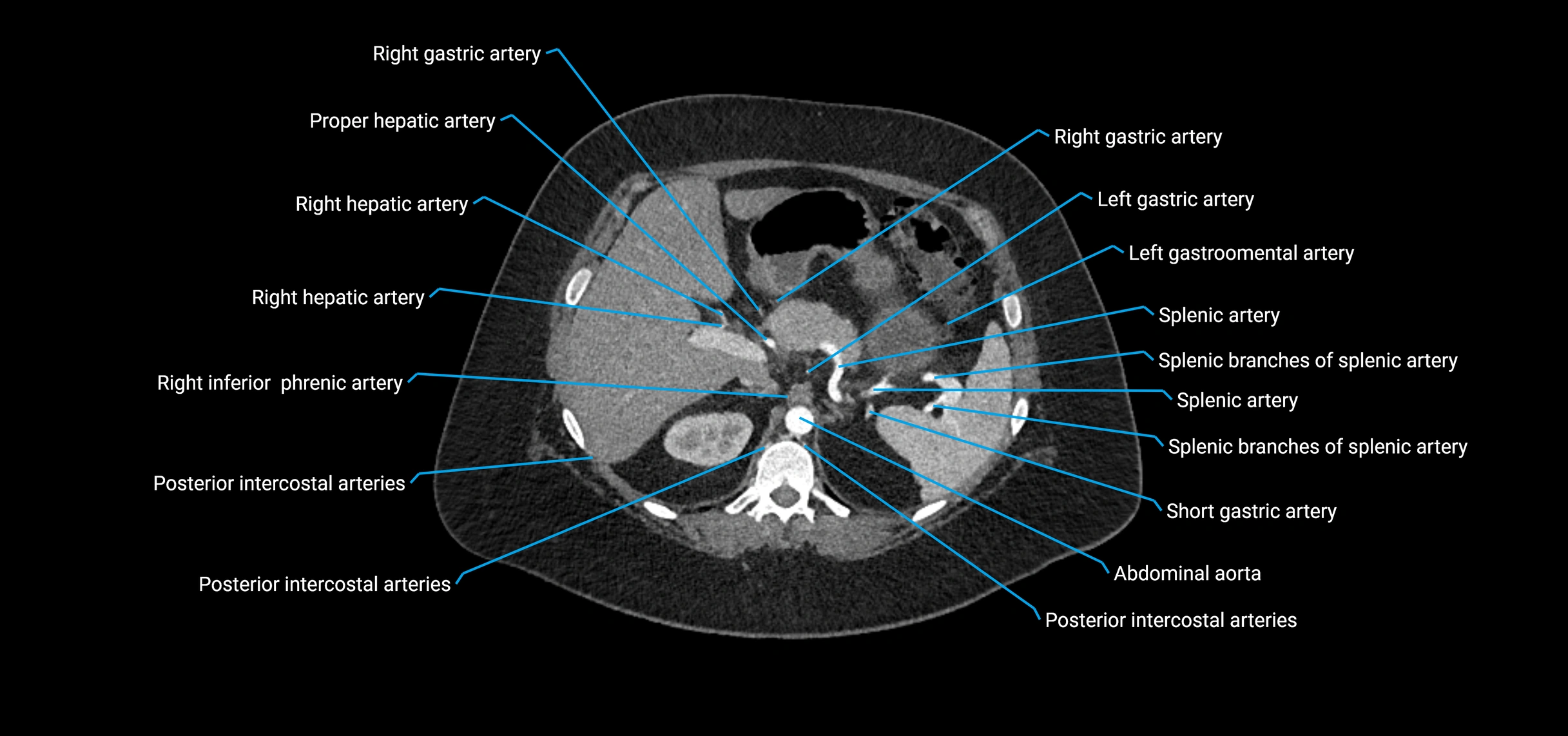 CTA abdomen axial cross sectional anatomy labelled image_47 (2).webp